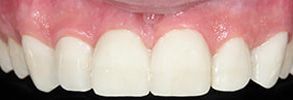 Smile Gallery - After