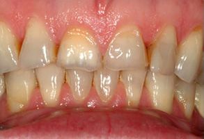 Smile Gallery - Before